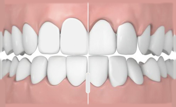 Исправление положения зубов