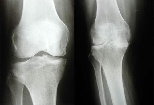 Причины артроза коленного сустава