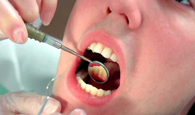 Радикулярная киста зуба