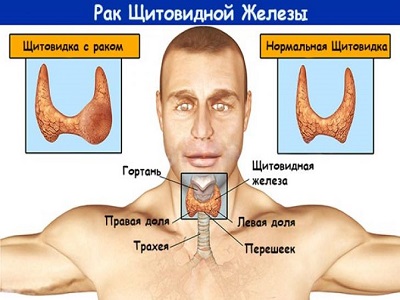 Рак щитовидной железы – это злокачественная опухоль, которая развивается из клеток этого органа.