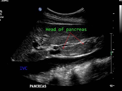 Выявление панкреатита на снимке УЗИ поджелудочной железы. Острые и хронические воспаления поджелудочной железы — самые распространенные заболевания среди обследуемых.